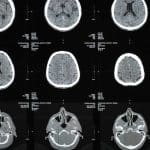 irm et sclerose en plaques comment cet examen detecte et suit la maladie 1