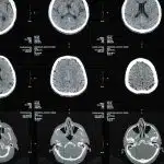 irm et sclerose en plaques comment cet examen detecte et suit la maladie 1