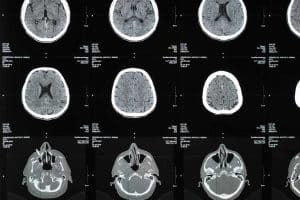 irm et sclerose en plaques comment cet examen detecte et suit la maladie 1