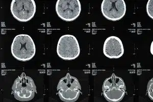 irm et sclerose en plaques comment cet examen detecte et suit la maladie 1