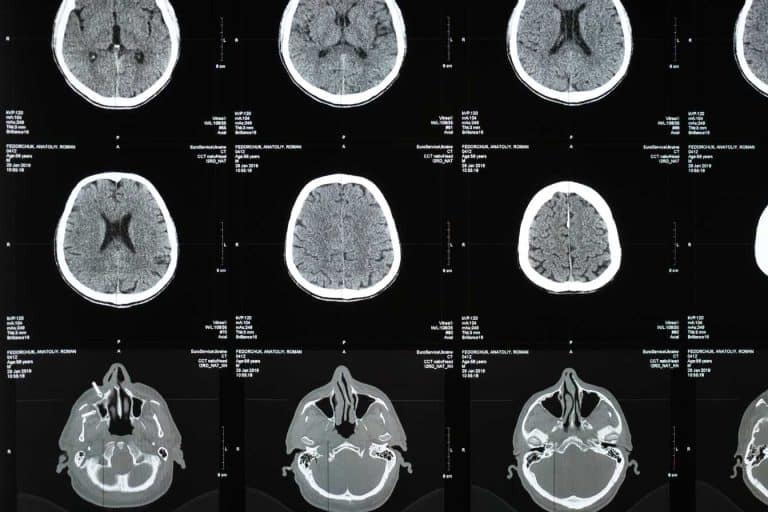 irm et sclerose en plaques comment cet examen detecte et suit la maladie 1