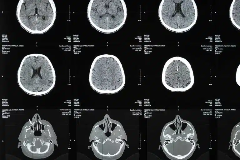 irm et sclerose en plaques comment cet examen detecte et suit la maladie 1
