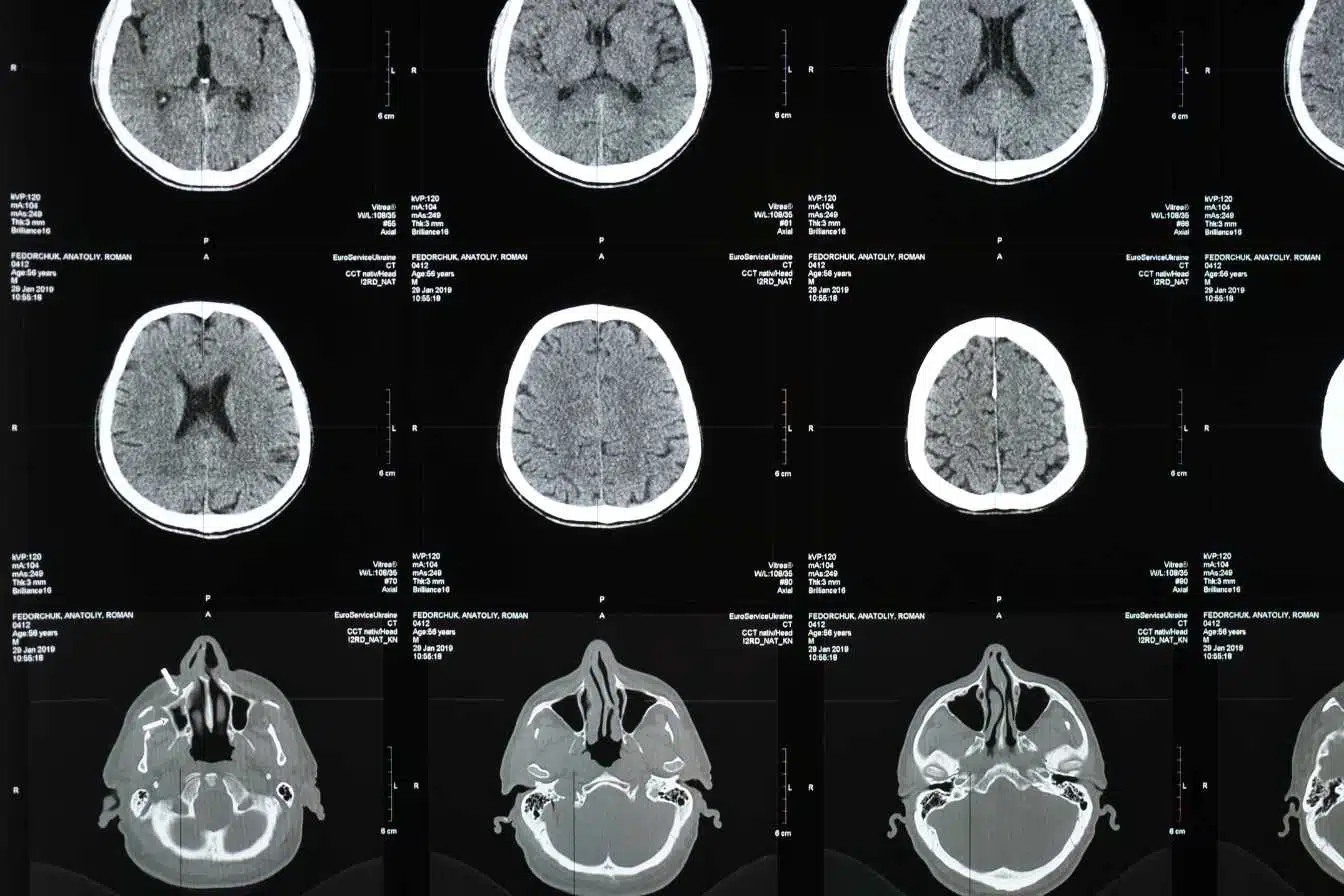 irm et sclerose en plaques comment cet examen detecte et suit la maladie 1