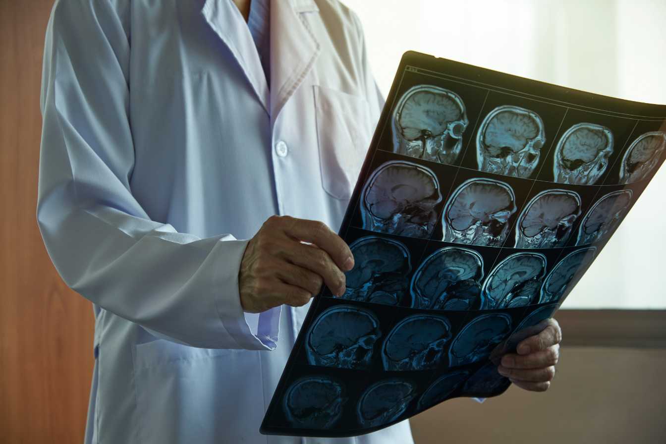 irm-et-sclerose-en-plaques-comment-cet-examen-detecte-et-suit-la-maladie-3