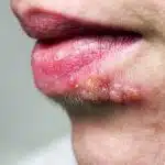 remede de grand mere pour les boutons de fievre 1