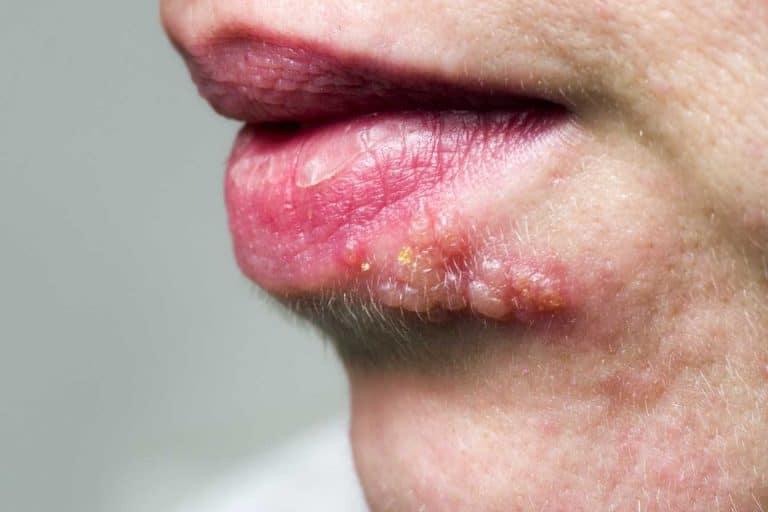 remede de grand mere pour les boutons de fievre 1