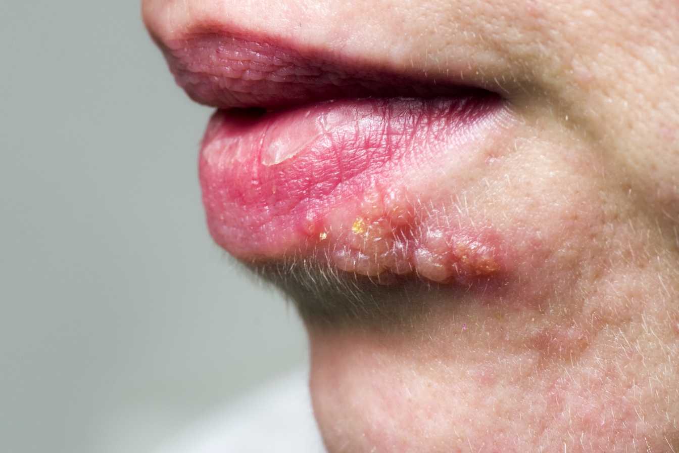 remede de grand mere pour les boutons de fievre 1