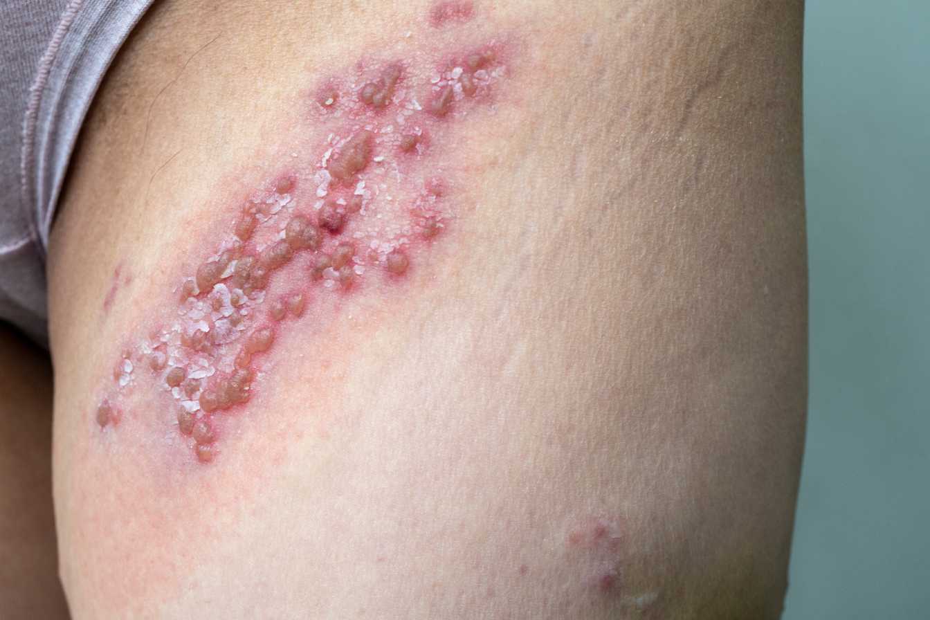 remede-de-grand-mere-pour-les-boutons-de-fievre-2