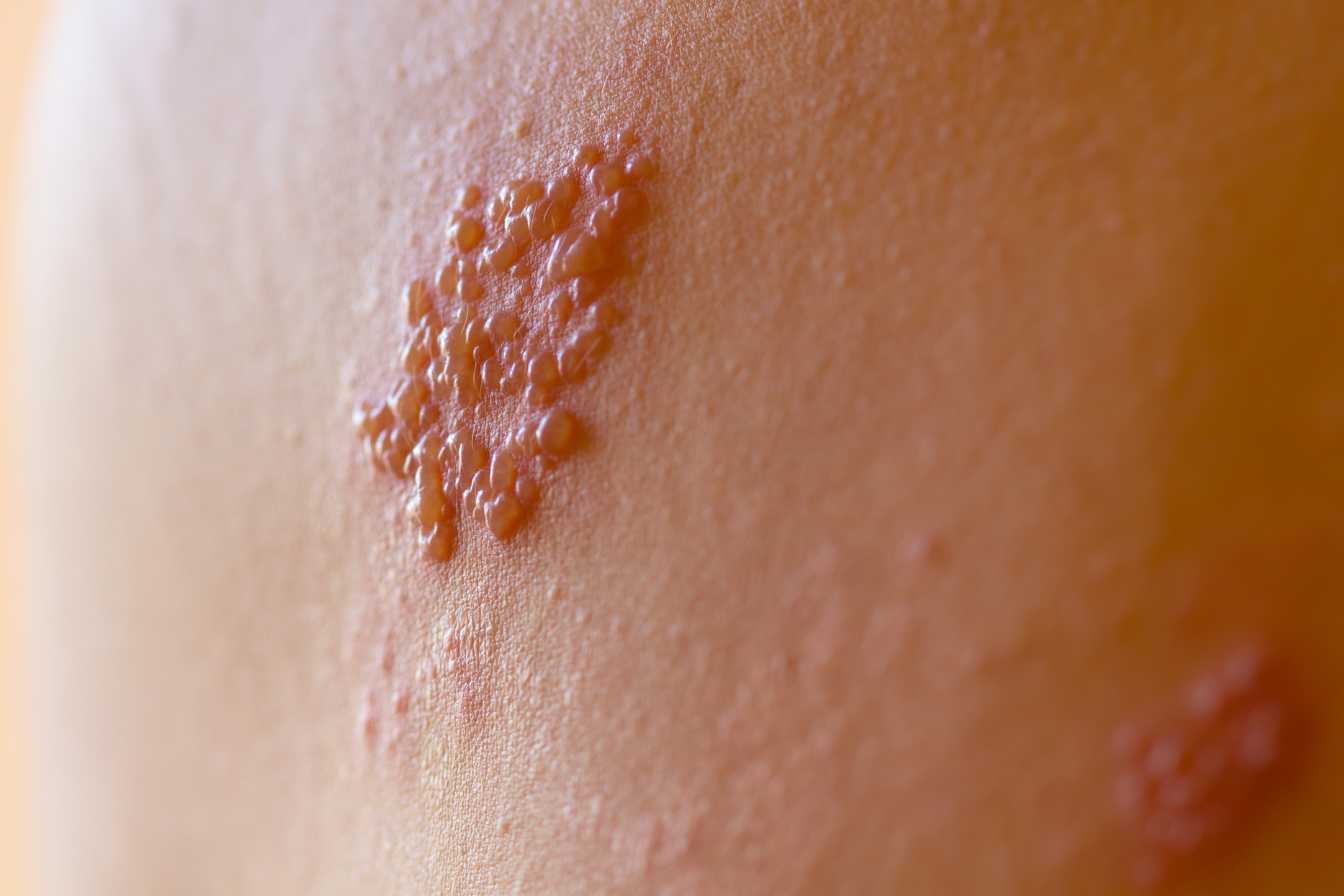 remede-de-grand-mere-pour-les-boutons-de-fievre-3